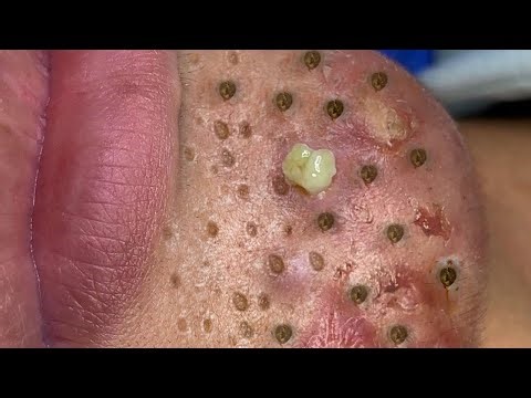 Blackhead Removal With Sac Dep Spa @100074783