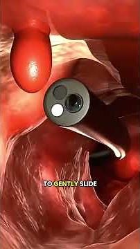 Polyp Removal Procedure Explained – Step by Step!