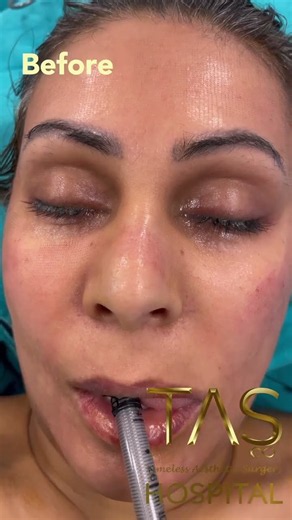 Scarless Facelift: How Is So Much Loose Skin Removed Without a Visible Cut? | Prof. Dr. Suleyman Tas