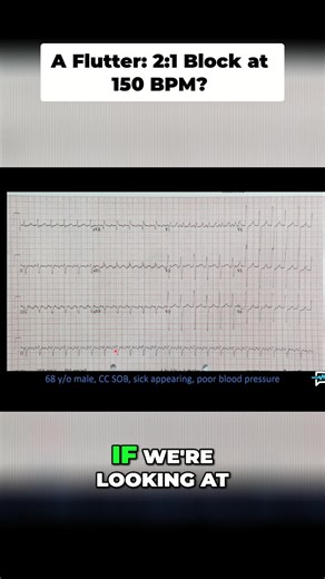 A-flutter ID cheat sheet! V1 & lead 2 are your best bets for spotting those flutter waves. Rate's at 150? Even more sus! #EKG #MedEd #NurseLife #Doctor #AFib