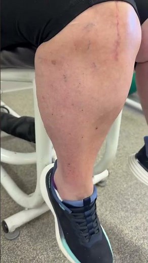 Knee Bends After Knee Replacement Surgery