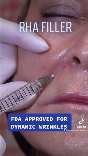 Reversing the Signs of Aging with RHA Filler