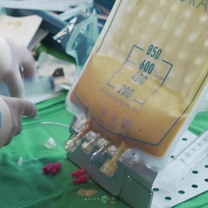 Fat Grafting to the Chest