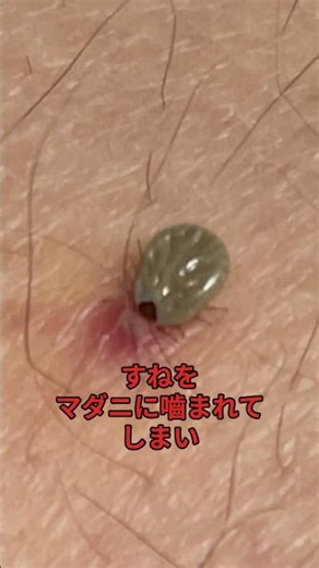 マダニに噛まれてしまいました ＃マダニ ＃ダニ ＃虫