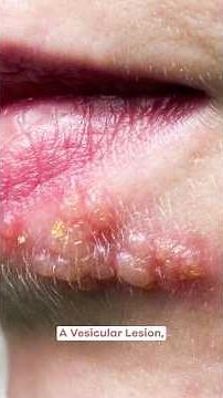 How You Get Herpes