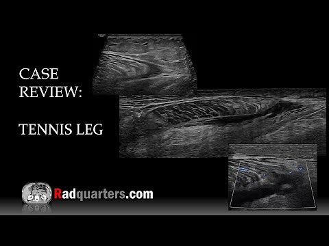 Ultrasound of Tennis Leg