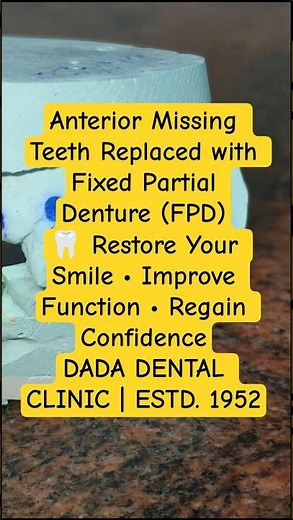 Anterior Missing Teeth Replaced with Fixed Partial Denture (FPD) | Natural Smile Restoration #shorts