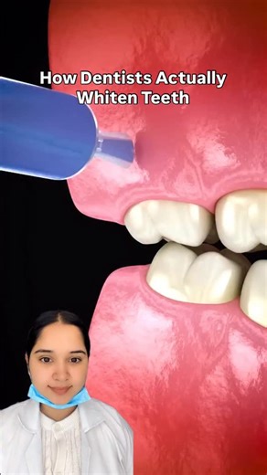 Dr. Aashita Sharma || Dentist & Creator on Instagram: "Teeth whitening isn’t “paint for teeth.” We use professional peroxide gel that releases oxygen molecules to break down stain pigments inside enamel. That’s how the shade lightens safely. 🦷✨ In clinic: • Gums are protected • Controlled gel is applied • Done in cycles to manage sensitivity Who can get it? ✔️ Healthy teeth & gums ✔️ Yellow / surface stains ✔️ Post braces staining Not suitable if: ❌ Cavities ❌ Gum disease ❌ Severe sensitivity ❌