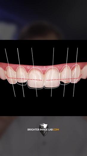 The Importance of Before/After Pictures in Smile Design | Brighter Image Lab