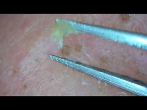 0251 keratin plug removal nose