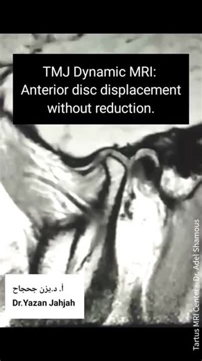 Diagnosis of Anterior Disc Displacement Without Reduction Using Dynamic Magnetic Resonance Imaging of the Temporomandibular Joint." | Prof. Dr. Yazan Jahjaha