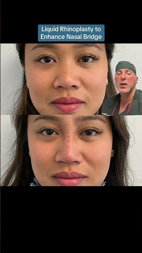Liquid Rhinoplasty To Enhance Nasal Bridge