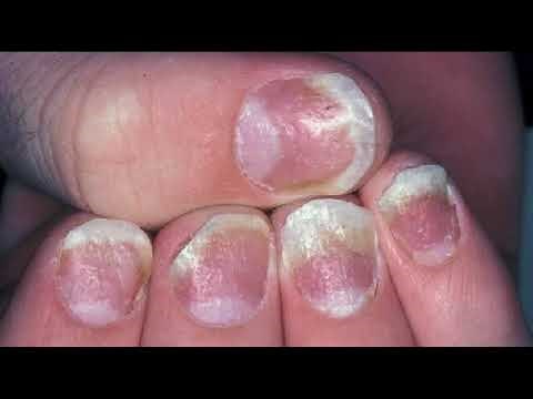 Nail Pitting on one finger Signs, causes, and treatment
