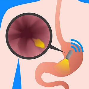 Capsule Endoscopy | Gastro Associates