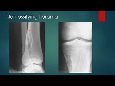 Non ossifying fibroma xray || Fibrous cortical defect xray || Radiology