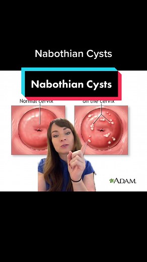 Understanding Nabothian Cysts: Causes, Symptoms, and Treatment