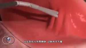 怎么做肺切除手术，3D演示。。