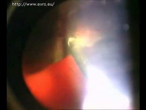 Vitrectomy Machine Choice Introduction