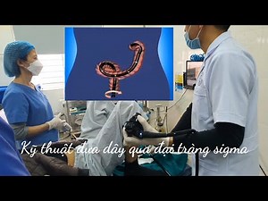 Kỹ thuật nội soi đại tràng: đưa dây soi qua đại tràng sigma 1