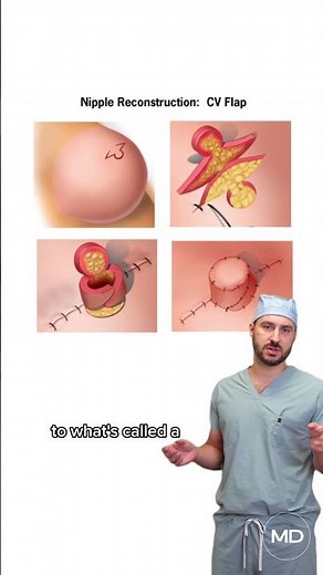 Nipple reconstruction is an integral part of restoring both form and confidence after a mastectomy.
