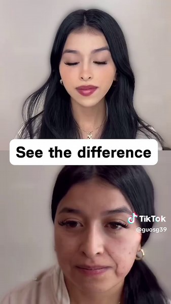 Facial Lifting: Achieving Coordinated Beauty