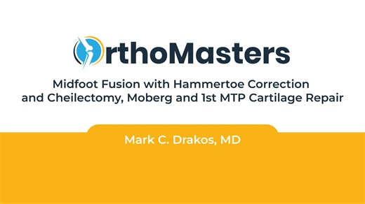 Midfoot Fusion with Hammertoe Correction and Cheilectomy Moberg and 1st MTP Cartilage Repair