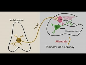 Mesial Temporal Sclerosis (MTS)