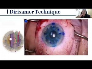 Lecture: Mastering DSAEK and DMEK – Tips and Tricks for Successful Corneal Transplantation