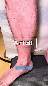 Dr. Kamran - Varicose Veins - Before & After - Angiodynamic Laser Treatment (EVLT)