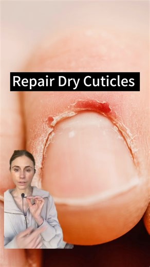 How to repair dry cuticles. Urea gel works wonders for dry cuticles and healthy nails. Petrolatum slathered to the nails keeps the nail folds hydrated and protected. #cuticles #nailcare #nailcareroutine #nailcaretips #dermatologist | Dr Dray