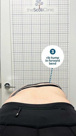Scoliosis Sign #3: Rib Hump in Forward Bend