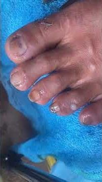 Thick toenail treatment