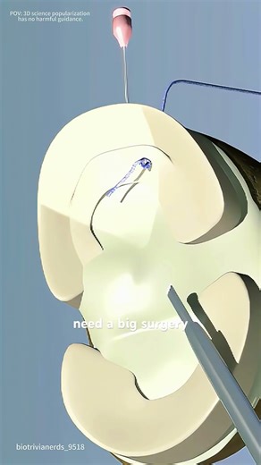 Meniscus tear surgery (3D animation) #music #motivation #epic #like