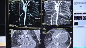 VIDEO: Editor’s Choice of the Most Innovative New Technology at TCT 2018 - DAIC Editor Dave Fornell takes a tour of some of the most innovative new cardiovascular technology he found on the expo floor at the 2018 Transcatheter Cardiovascular Therapeutics (TCT) conference — https://www.dicardiology.com/videos/video-editor’s-choice-most-innovative-new-technology-tct-2018 Link to more TCT 2018 news and videos — https://www.dicardiology.com/channel/tct Here are links to other Editor's Choice videos 