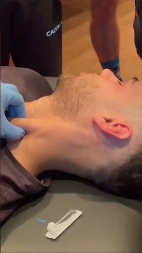 Dry Needling to the SCM for neck pain #acupuncture #scm #dryneedling