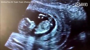 A very bouncy unborn baby has been captured dancing inside its mother's womb! 💃 The adorable footage was captured on ultrasound during a scan at a Chinese hospital, much to the delight of the parents! | Right To Life UK