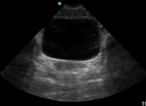 FAST Exam: Normal Suprapubic - JETem