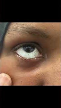 Conjunctival Naevus Removal in London and the UK #bluefinvision #eyecare #london #harleystreet