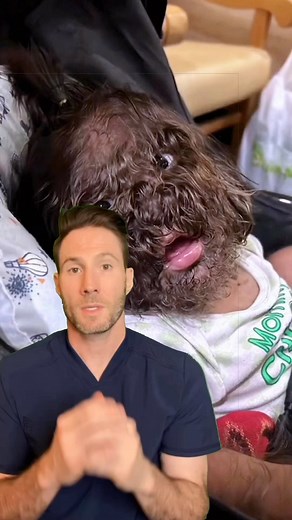 Hypertrichosis is a rare condition characterized by excessive hair growth anywhere on a person’s body. It can be congenital or acquired, with the congenital form often caused by genetic mutation. The hair growth associated with this syndrome can be extensive, covering large areas of the body, which has led to its folklore-inspired name. Treatment mainly involves hair removal techniques, but there is no cure for the underlying cause. #werewolf #doctor #medical #raredisease #werewoldsyndrome | Dr.