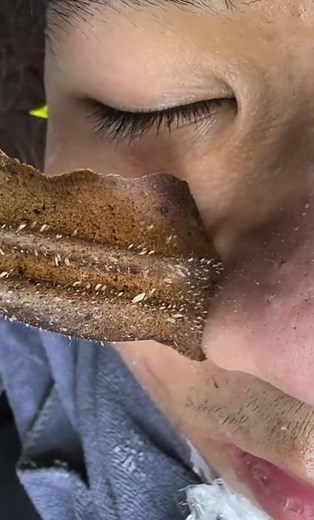 04-Extreme Blackhead Removal | #tweezers skincare #blackheads blackheads #foypage #acnetreatment