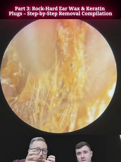 Rock-Hard Ear Wax & Keratin Plugs – Step-by-Step Removal Compilation (3)#rock #hard #wax