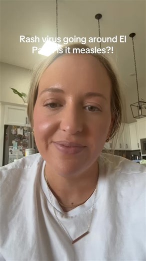 Dr. Lindsey Herrera on Instagram: "👶 “Slapped cheeks” and a lacy rash? It might be Parvovirus B19, also known as Fifth Disease — a common childhood virus that’s often mistaken for something more serious. ✨ Unlike measles, which can also cause a full-body rash, it also comes with high fever and serious risks. Whereas, parvovirus is usually mild in healthy children. The rash may look dramatic, but by the time it shows up, your child is typically no longer contagious. 🚫 And no — this isn’t the sa