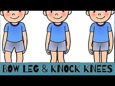 Bow leg and Knock Knees in Children, when is it normal, and when should we consult our Pediatrician?