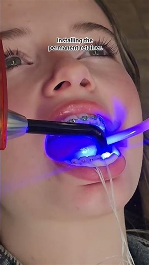 👉 POV: Getting a permanent retainer installed #orthodonticbraces
