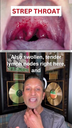 STREP THROAT Symptoms