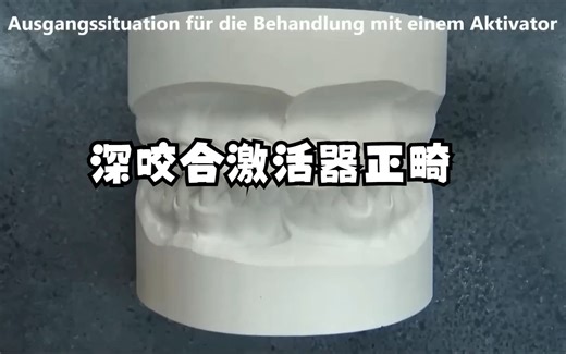 深度咬合激活器正畸