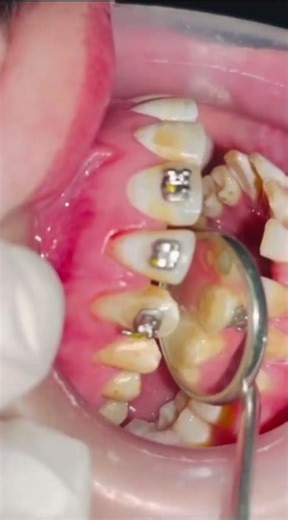 Braces Placement On Teeth #orthodontist