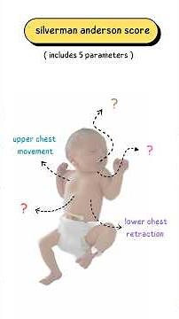 What is Silverman Anderson Score ( SAS ) or Silverman score for respiratory distress in newborn, rds