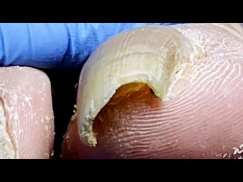If Your Toenails Are Curved And Ingrown, See A Doctor Immediately【Podiatry Clinic】