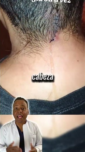 🧠Symptoms and risks of cerebrospinal fluid loss #shortvideo #feedshorts